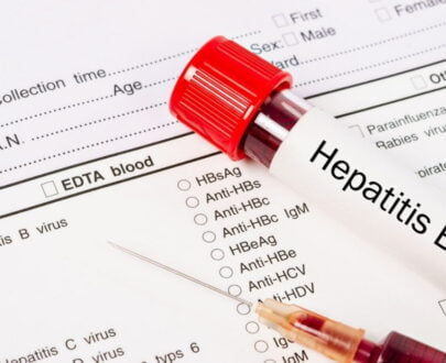 Hepatitis-B Virus test