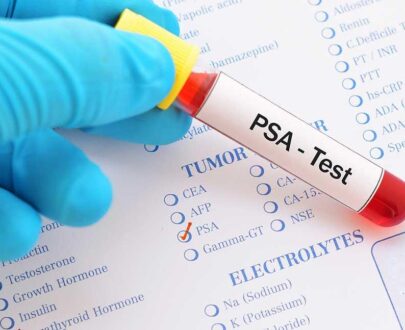 Prostate-Specific Antigen Test
