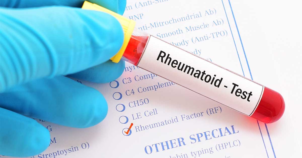 rheumatoid-factor-test