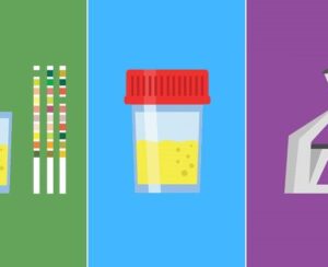 Urinalysis (urine test)