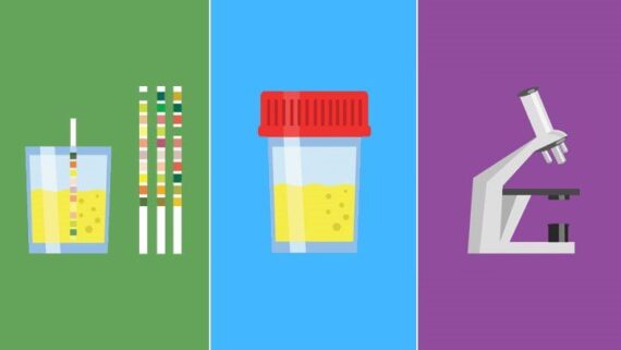 Urinalysis (urine test)